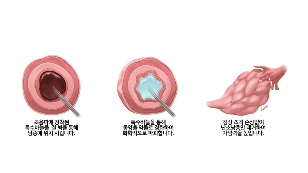 난소낭종 경화술 수술 방법
