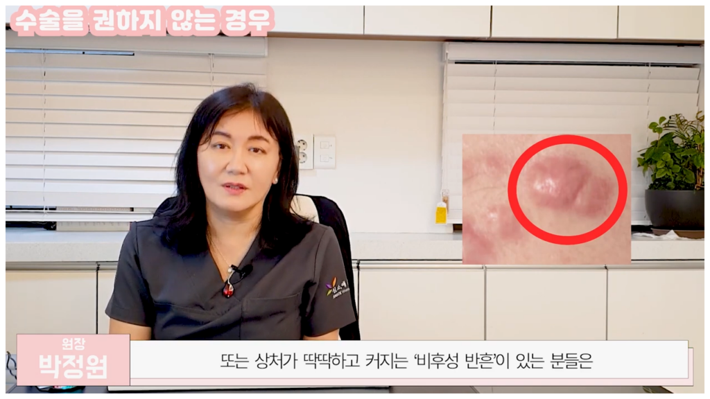 비후성반흔이 있는 분들이 소음순 성형을 하는 경우