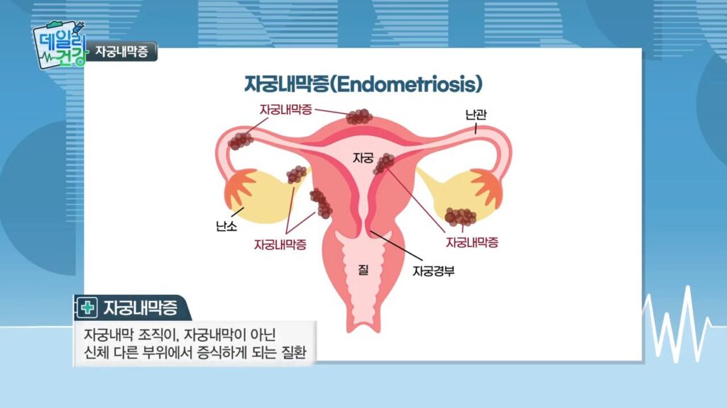 [쿠키 TV 데일리건강] 자궁내막증에 관련된 설명 사진
