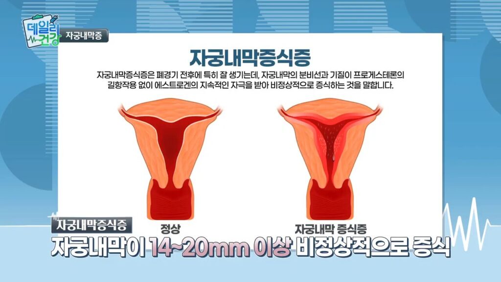[쿠키 TV 데일리건강] 자궁내막증식증에 관련된 설명 사진