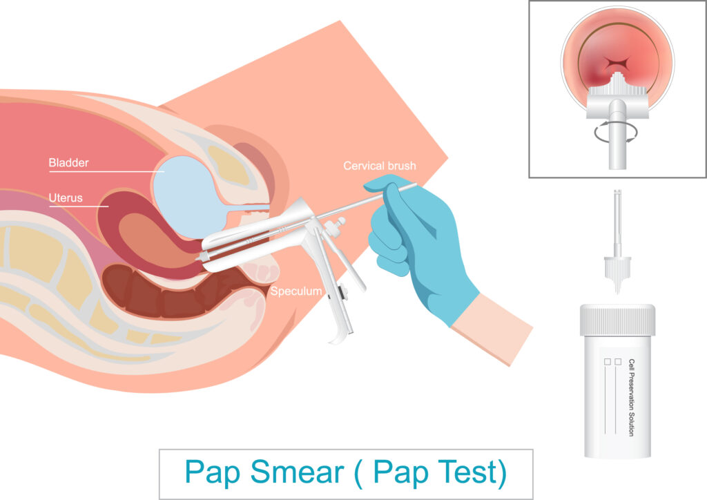 자궁경부암검진 