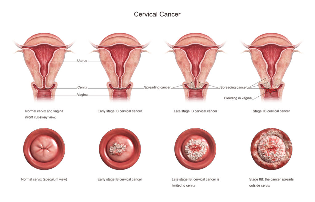 자궁경부암 분류 