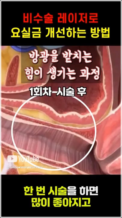 비수술 레이저로 요실금 개선하는 방법 1