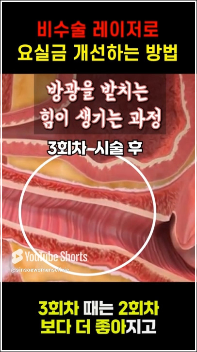 비수술 레이저로 요실금 개선하는 방법 3