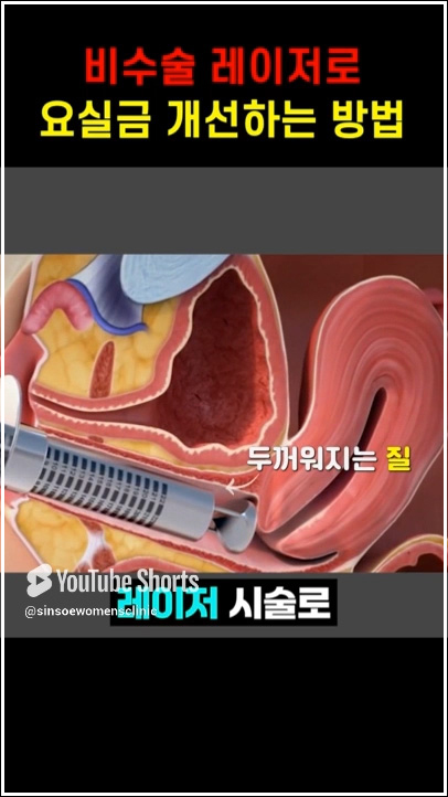 비수술 레이저로 요실금 개선하는 방법 4