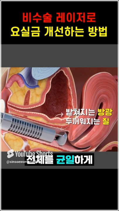 비수술 레이저로 요실금 개선하는 방법 5