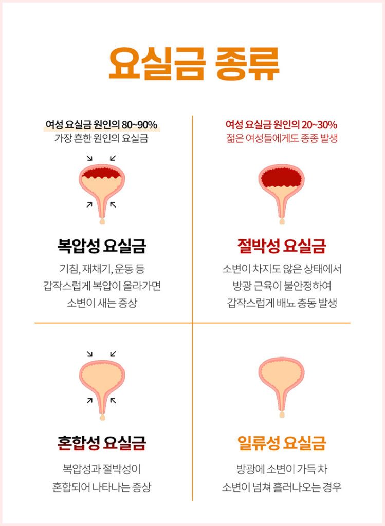 요실금 종류