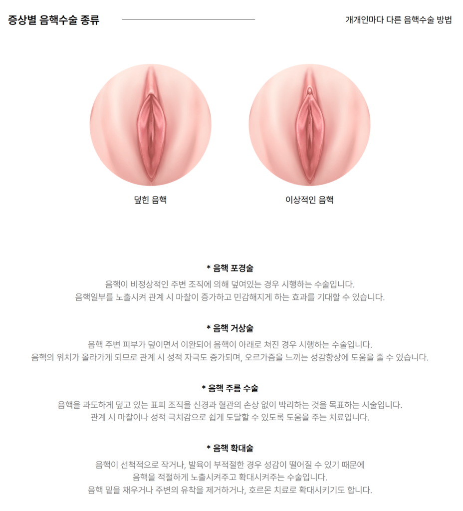 다양한 음핵성형 방법