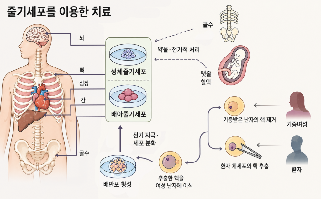 줄기세포를 이용한 치료