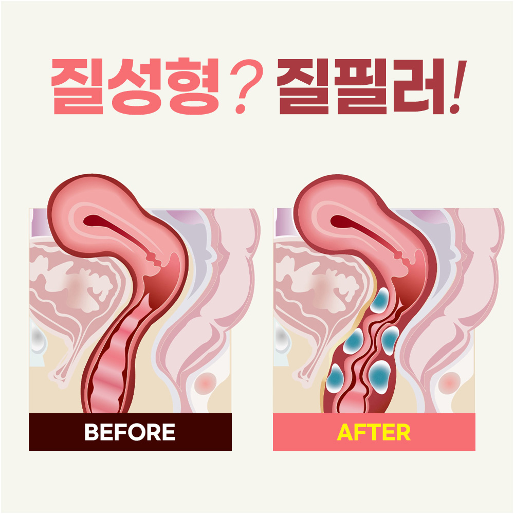 질성형과 질필러, 어떻게 다른가요?