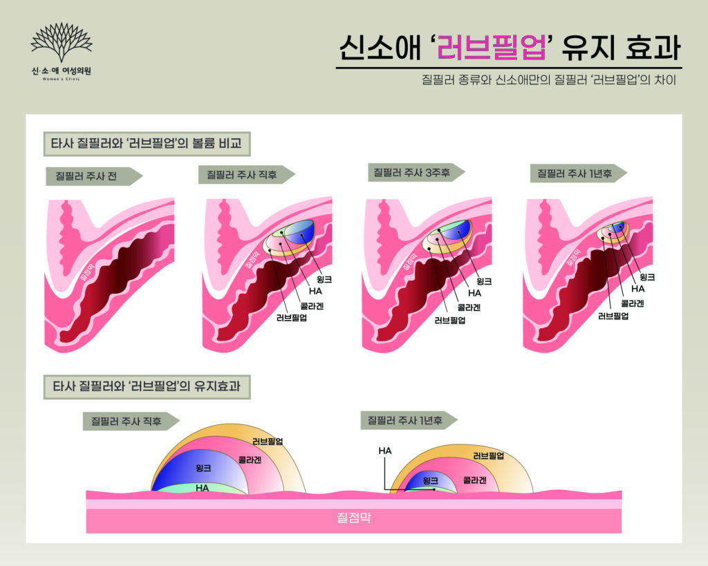 질필러 차이와 유지 효과