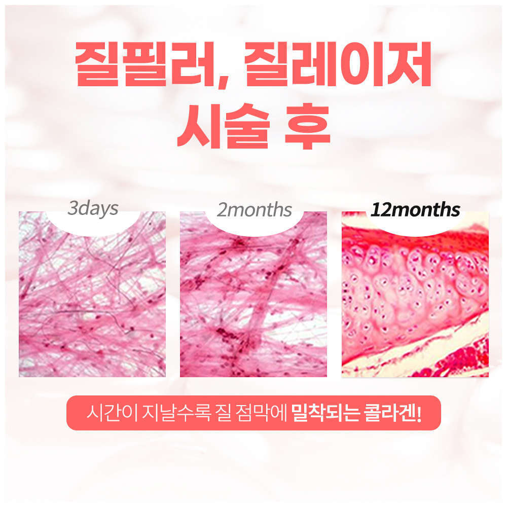 질필러와 질레이저 병합 시술 효과