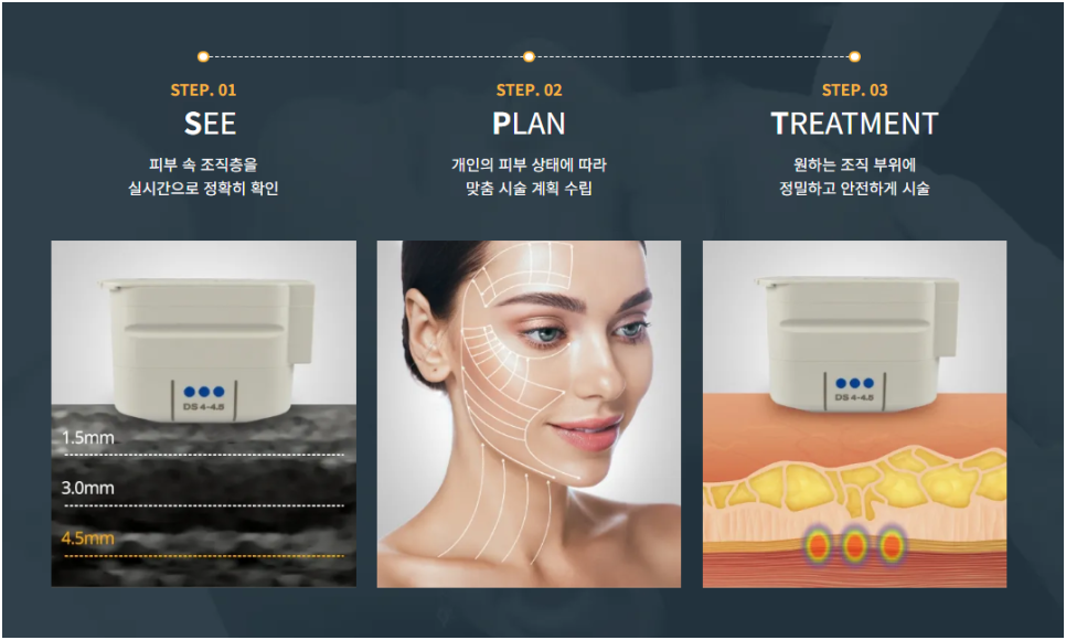 울쎼라 리프팅 시술 방법
