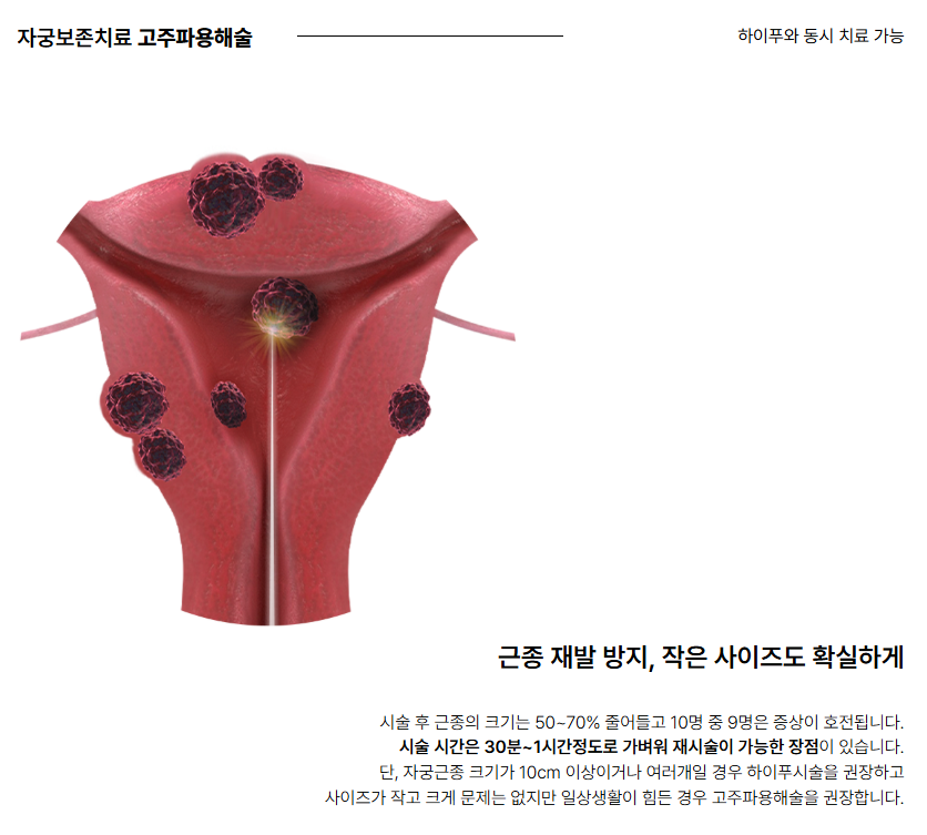 고주파용해술 치료