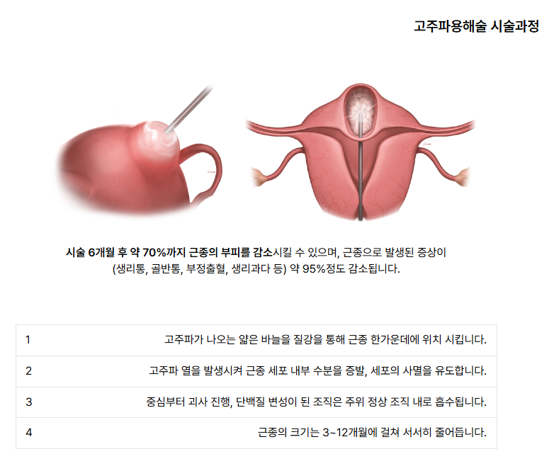 고주파용해술 시술과정