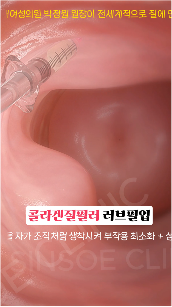 러브필업 시술 과정 2