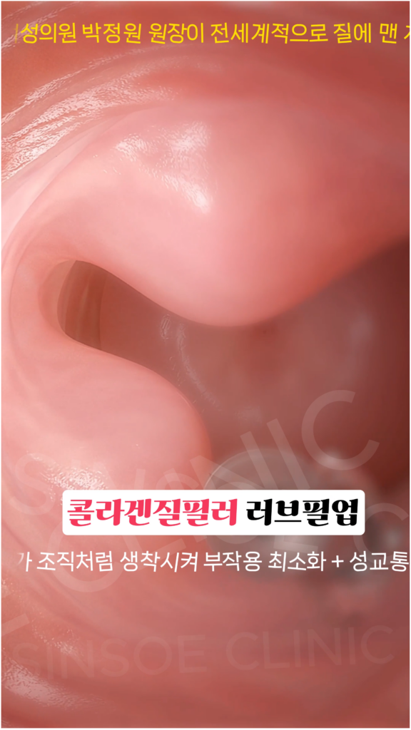 러브필업 시술 과정 3