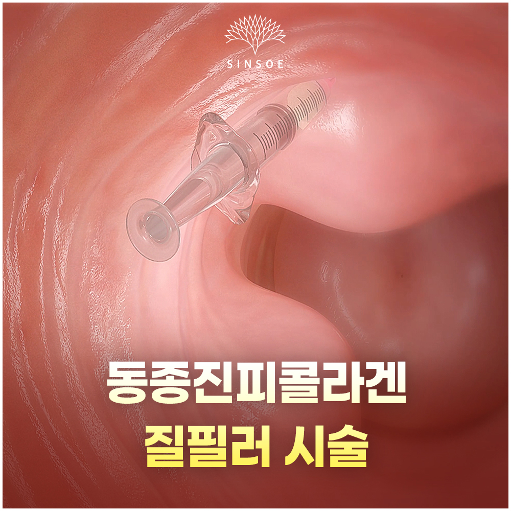 동종진피콜라겐 질필러 러브필업 효과와 시술 유의점