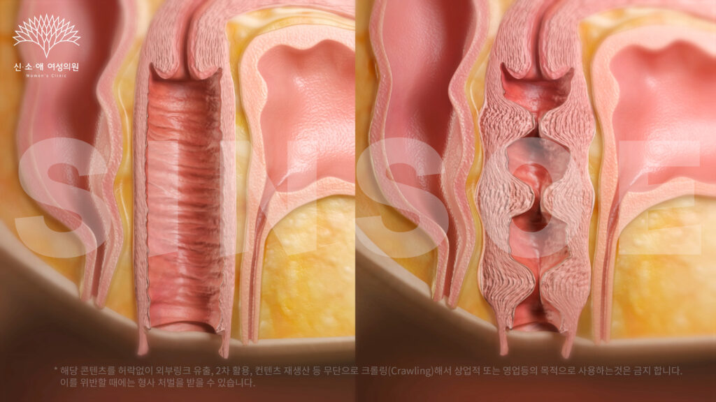 질필러 비포애프터