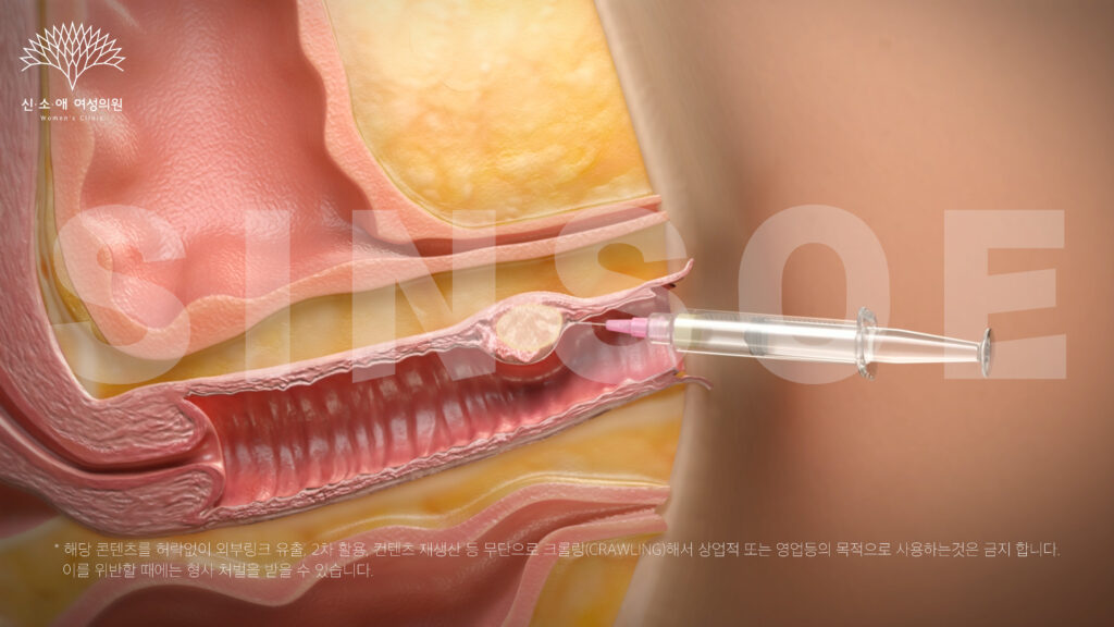 질필러를 주입하는 장면
