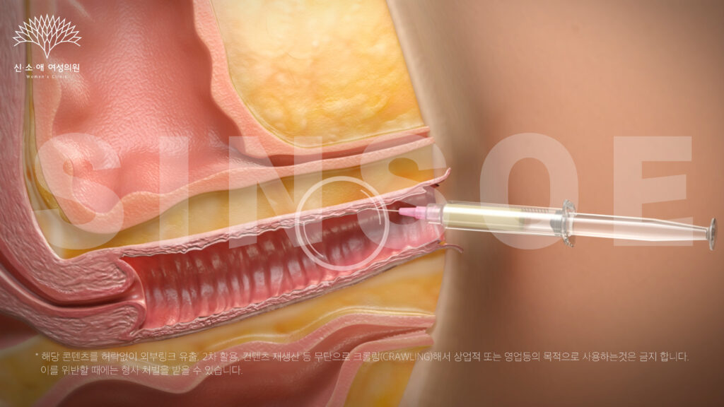 지스팟 부위에 질필러를 주사하는 장면