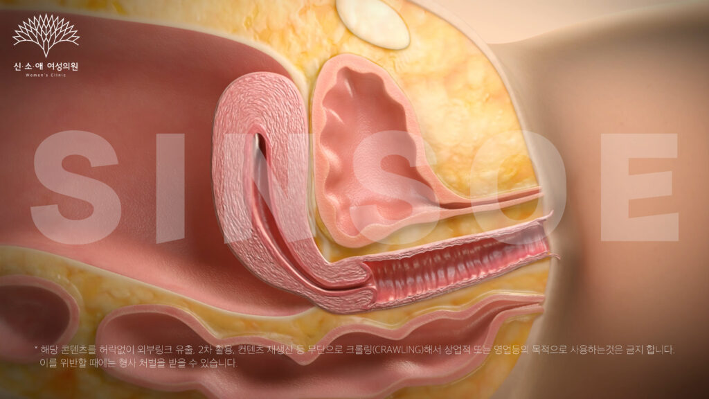 질필러 하기 전