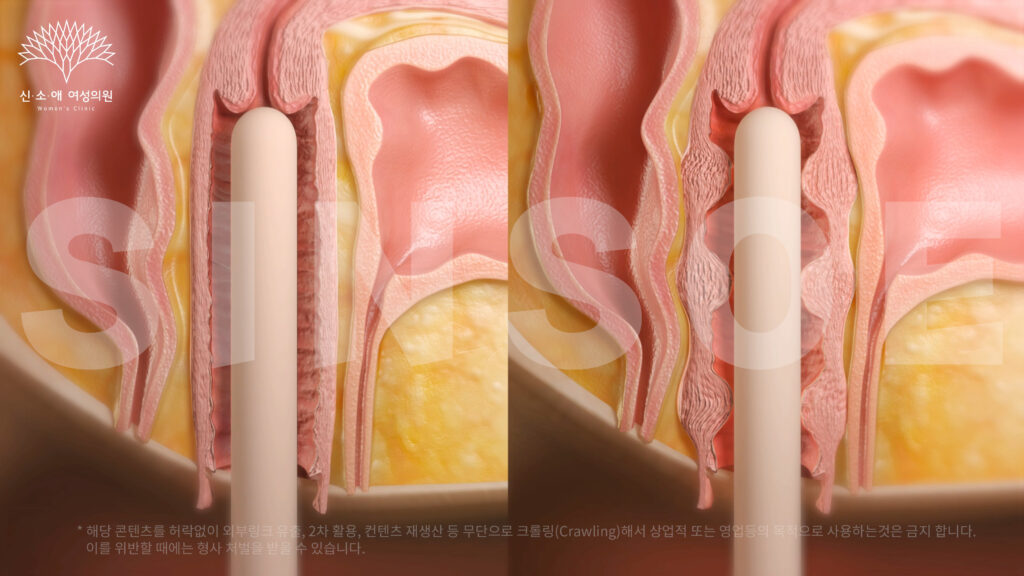 질필러 전후사진