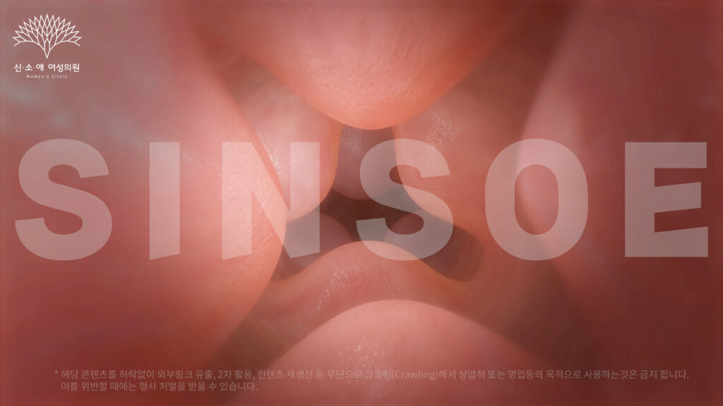 질필러 삽입 사진 6