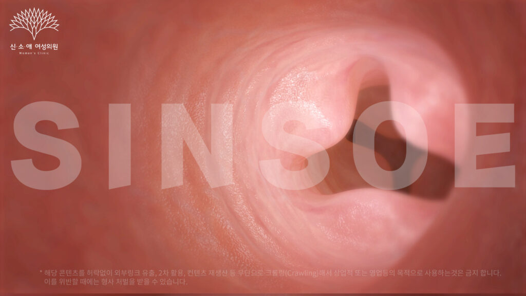 질필러 삽입 사진 5