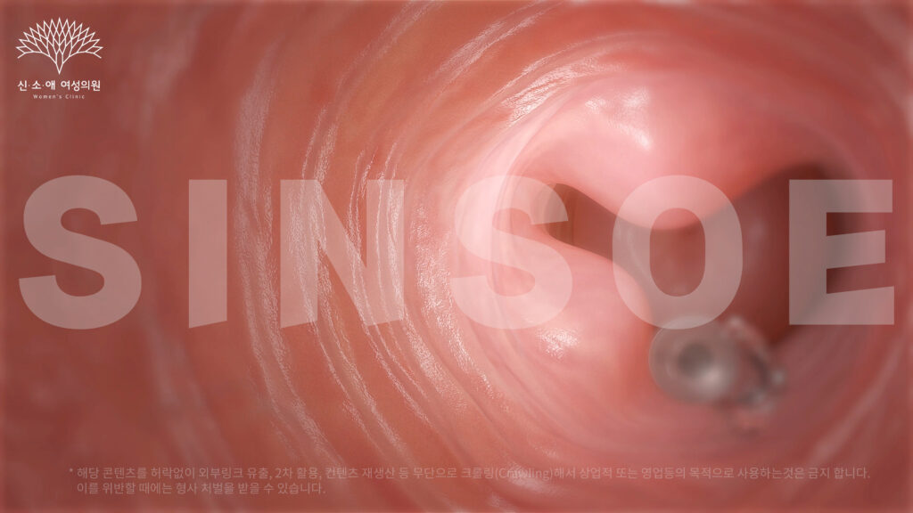 질필러 삽입 사진 4