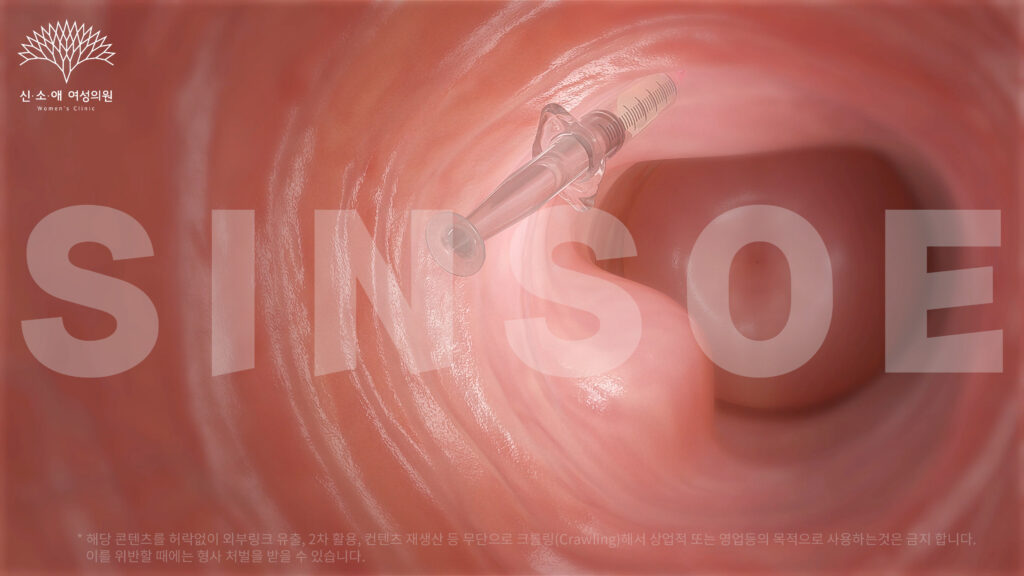질필러 삽입 사진 3