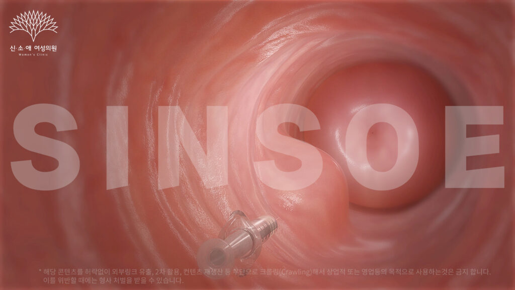 질필러 삽입 사진 2