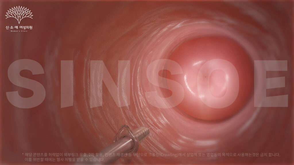 질필러 삽입 사진 1