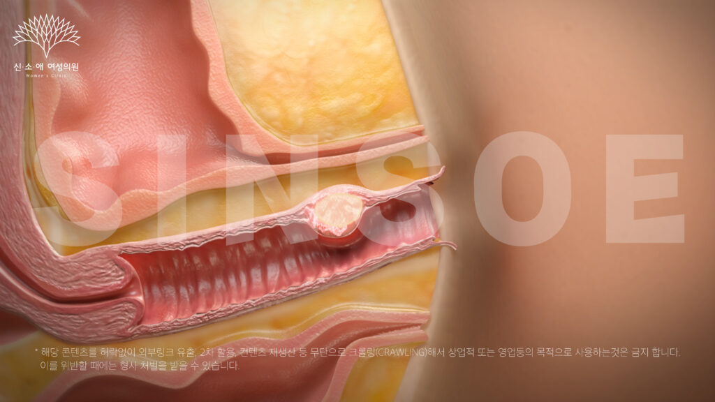 질필러 후