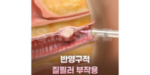 반영구적 질필러 조직 시술 부작용