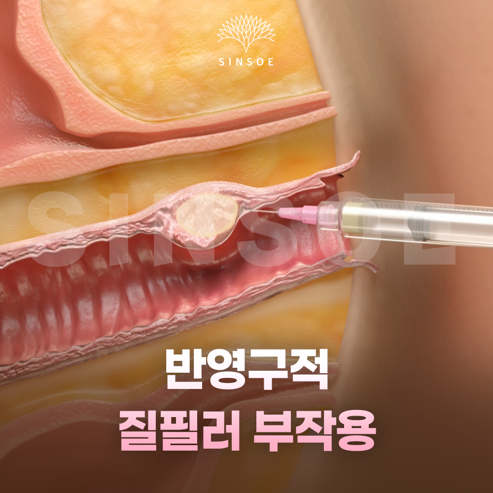 반영구 질필러 부작용에 대하여 썸네일