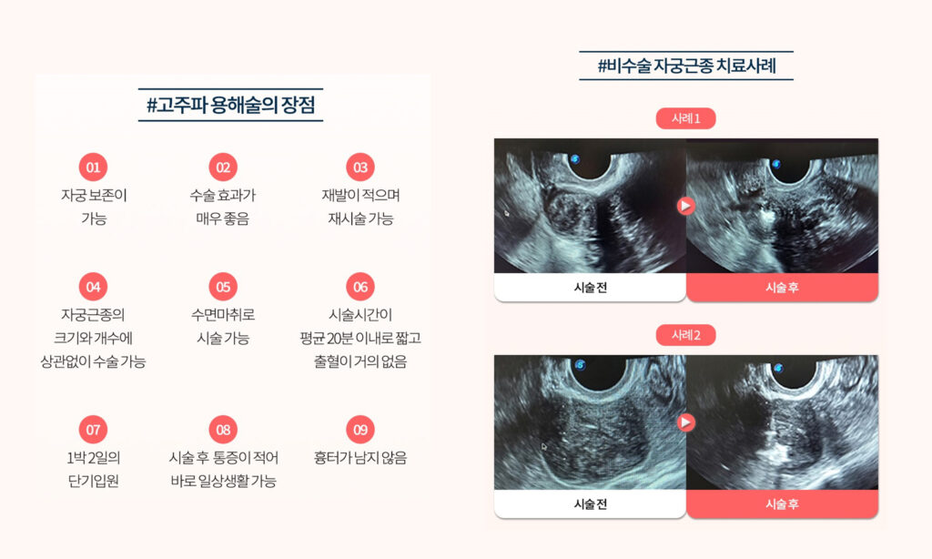 고주파용해술 장점 및 치료사례