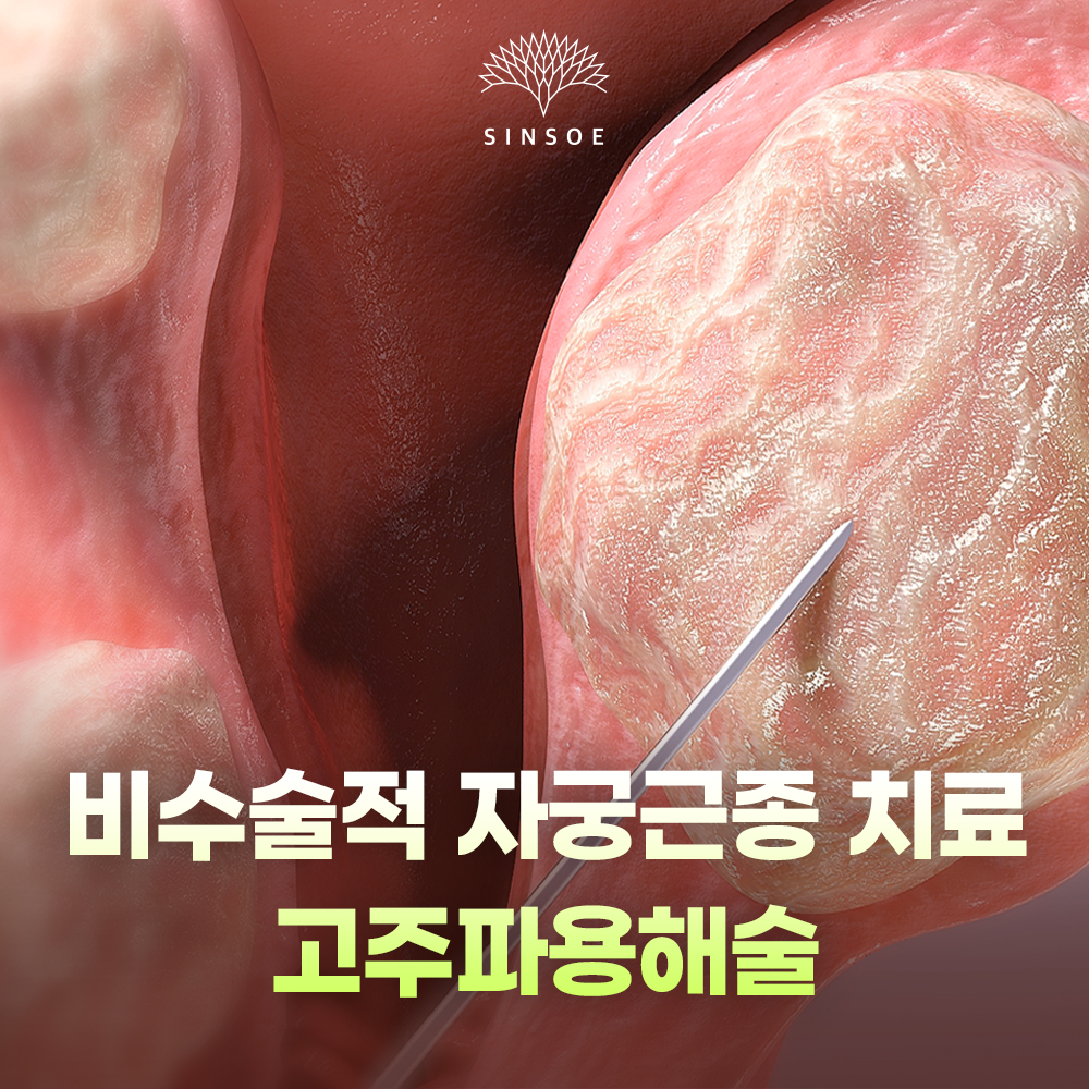 자궁근종 치료, 고주파용해술과 하이푸