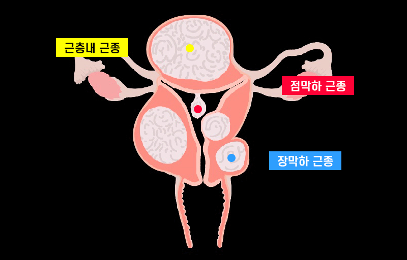 자궁근종 발생 위치
