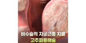 자궁근종 치료, 고주파용해술과 하이푸