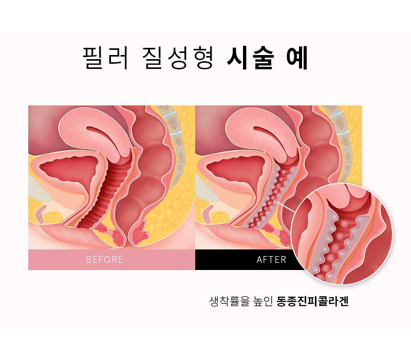 러브필업 질필러 전후 사진