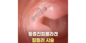 동종진피콜라겐 질필러시술 러브필업
