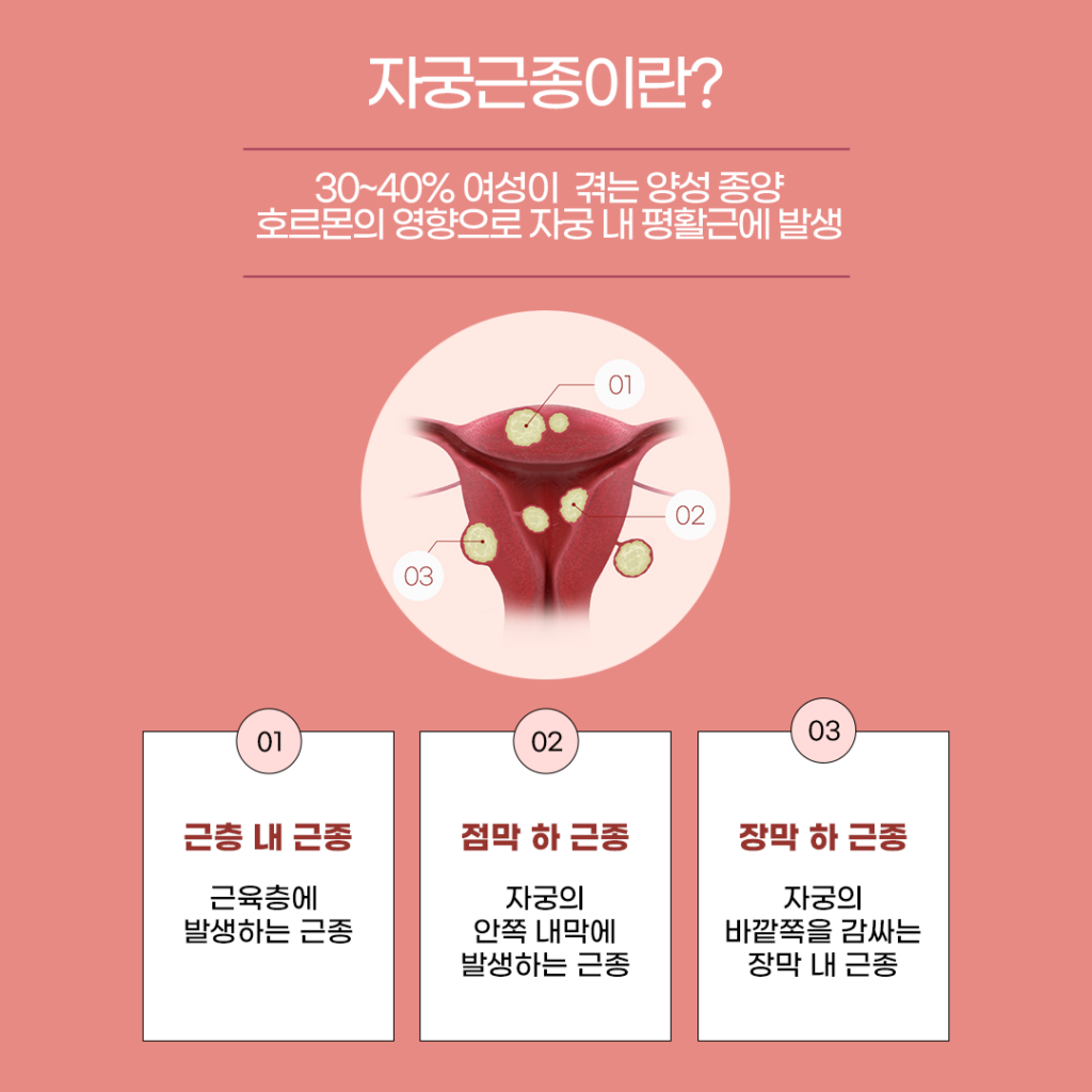 자궁근종이란?