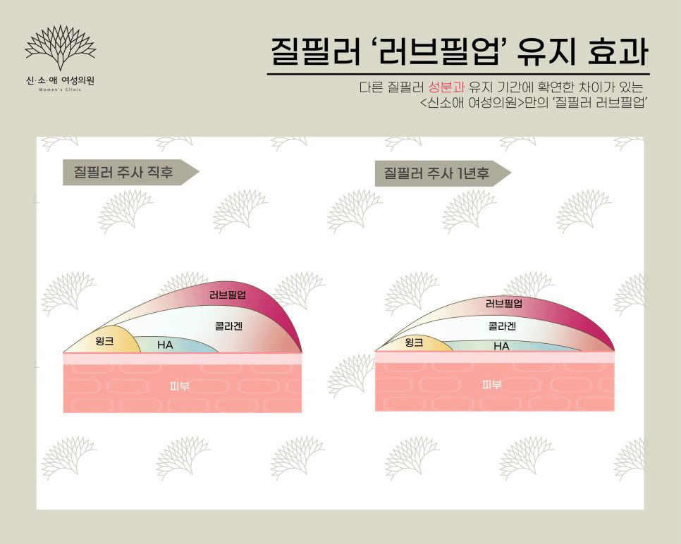 러브필업 유지기간 질필러효과