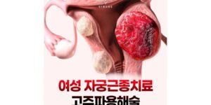 자궁근종 치료, 자궁을 보존하는 고주파용해술(RFA)