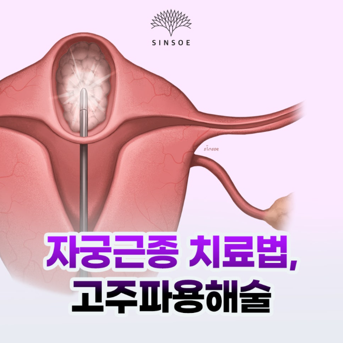 자궁근종 치료 방법, 자궁근종용해술