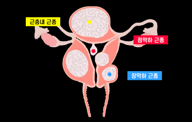 자궁근종 위치 / 자궁근종 종류