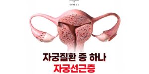 자궁적출술 없이 가능한 자궁선근증 치료방법