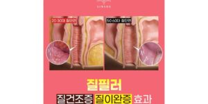 질필러 시술, 질건조증과 질이완증 개선에 도움이 될 수 있을까?