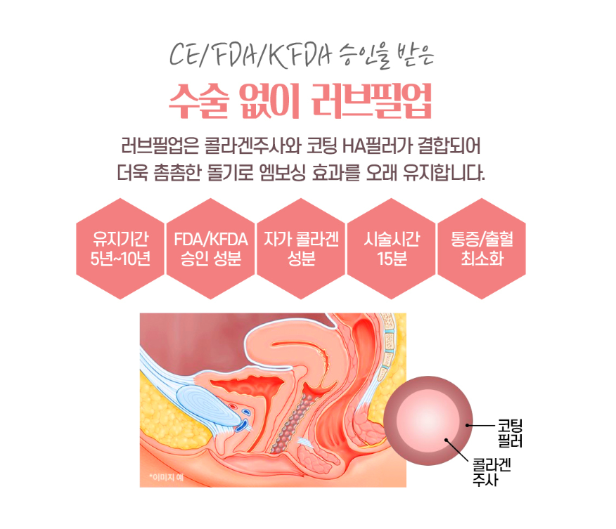 러브필업 질필러 시술 원리